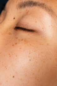 Dark Spots