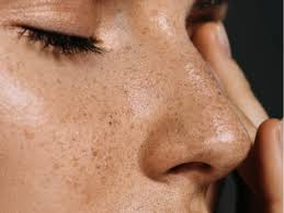 Freckles